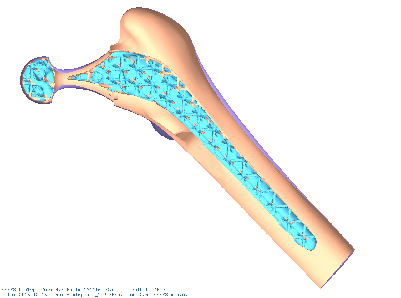Topology Optimization Hip Implant in Femur Bone